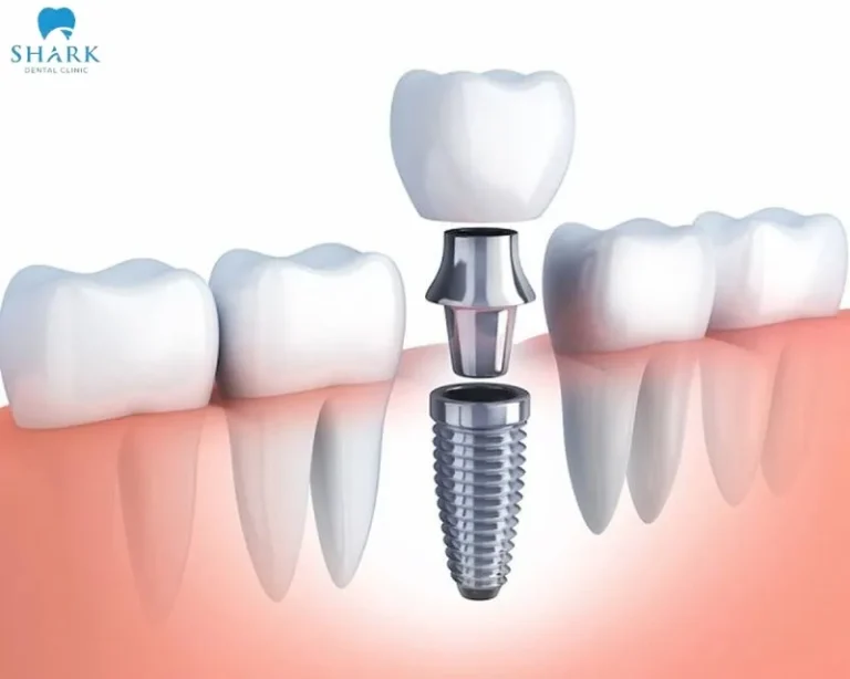 Porcelain crowns can last stably for 10–15 years, and even over 20 years with premium ceramic types. Porcelain crowns can last stably for 10–15 years, and even over 20 years with premium ceramic types.