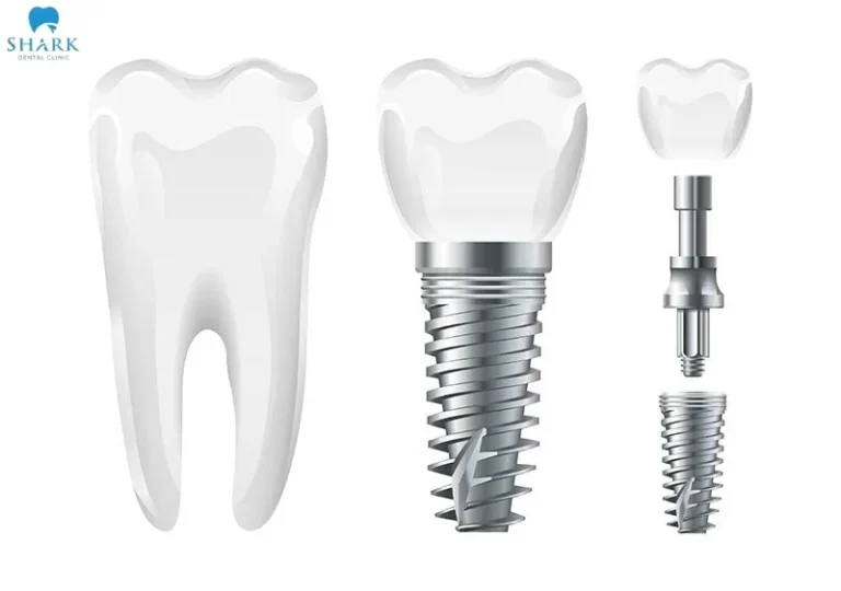 How long a dental implant lasts also depends on the quality of the implant post and the dental crown material