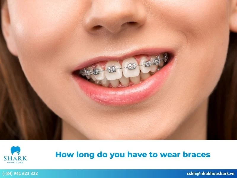 How long do you have to wear braces