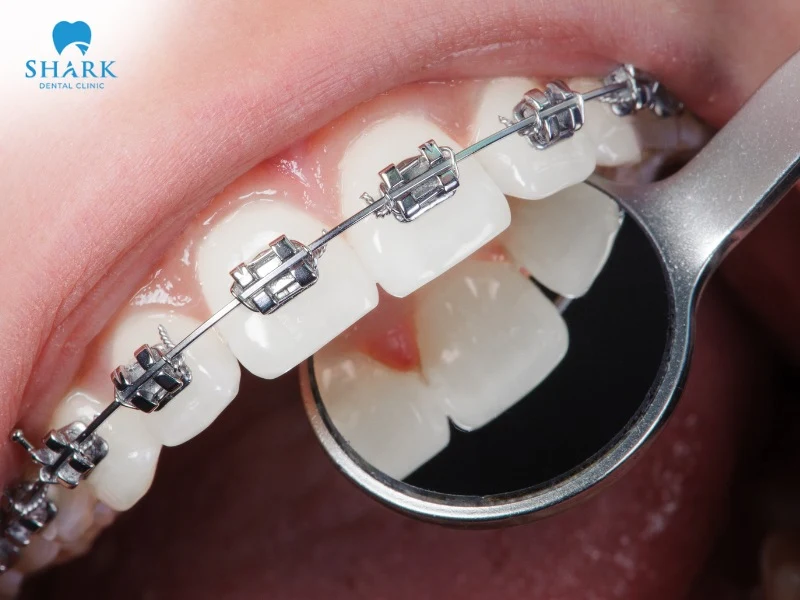 People with braces usually need to wear orthodontic appliances for about 12 to 36 months to allow the teeth to shift into the desired position