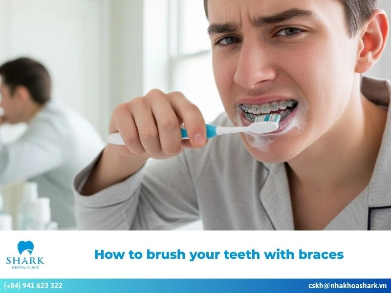 How to brush your teeth with braces