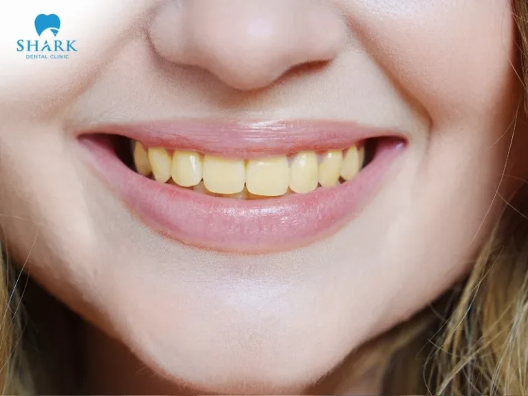 Yellow or black plaque that is not properly cleaned from teeth can affect aesthetics and increase the risk of cavities and gum disease