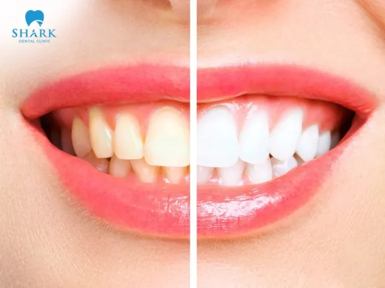 You need to distinguish between plaque and tartar in order to clean your teeth properly