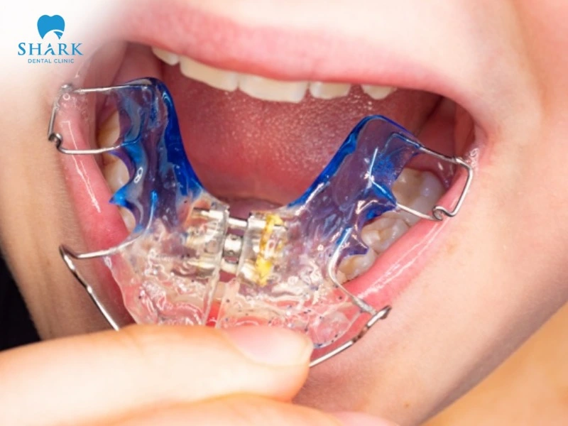 Expander trays are commonly used for children to create enough space for permanent teeth to grow in the correct position