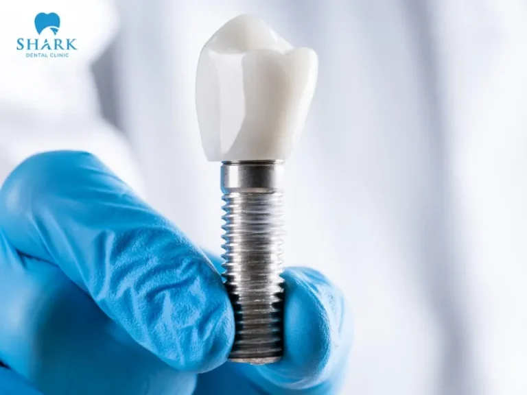 Hybridge implants are an advanced restorative method that combines dental implants with dentures