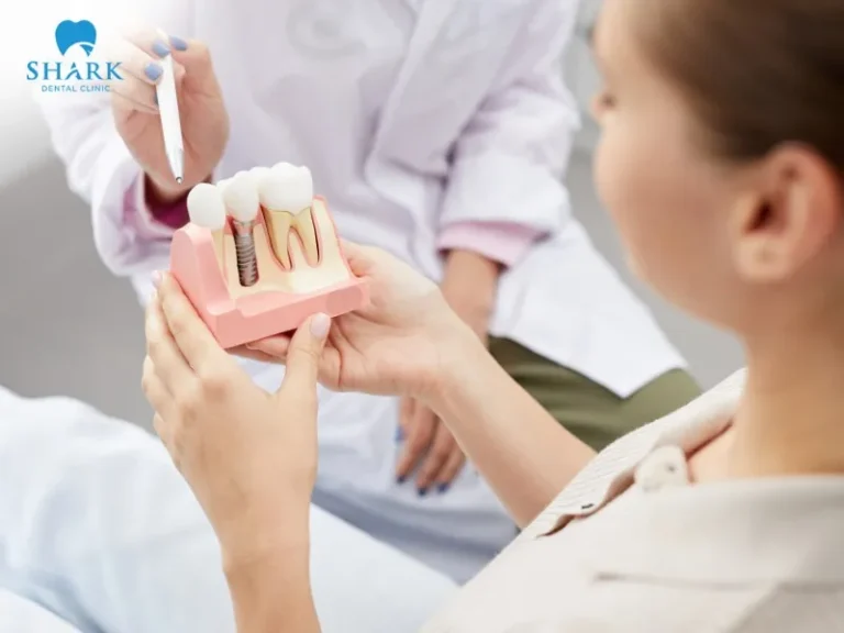 The cost of Hybridge dental implants at the clinic ranges from $20,000 – $30,000 per arch