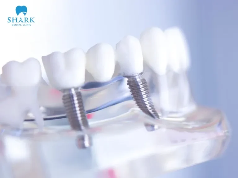 Hybridge dental implants can last permanently if patients follow oral care and hygiene instructions