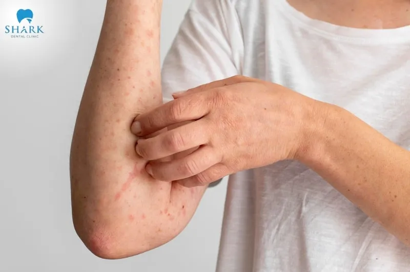 Overusing antibiotics can cause anaphylactic shock, accompanied by symptoms such as skin rashes and difficulty breathing