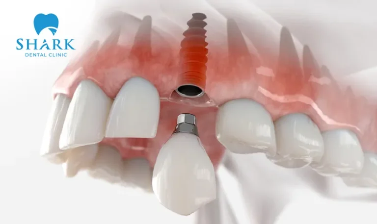 After a dental implant procedure, there are cases where the implant becomes loose and causes complications