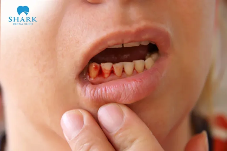 Bleeding after getting dental implants is one of the possible complications following implant surgery