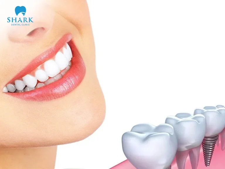 Pay close attention to proper oral care and hygiene after dental implant placement