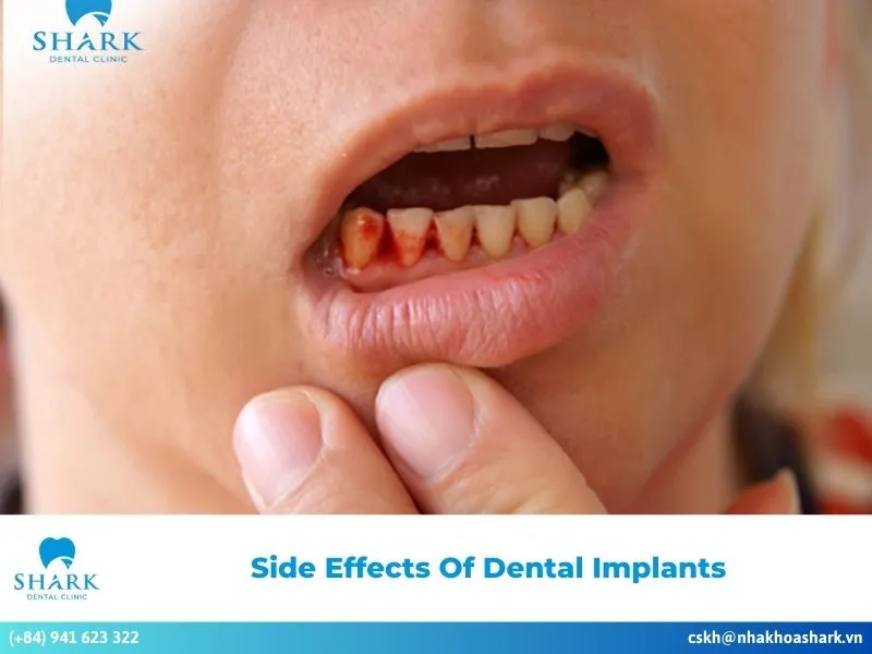 Side effects of dental implants