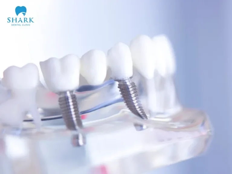 Titanium Dental Implants use a type of Titan ceramic tooth that consists of two parts: an outer ceramic layer and an inner core made from a titanium alloy