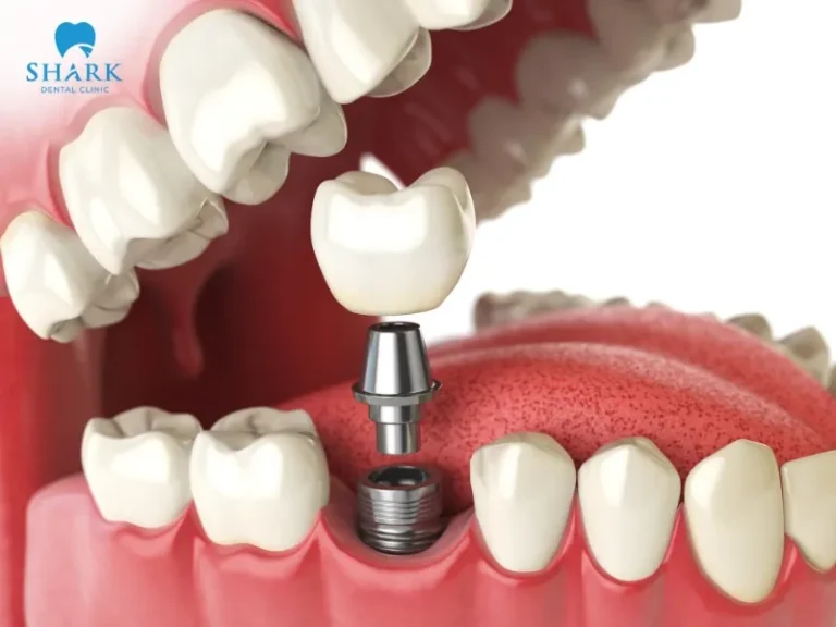 The cost of titanium ceramic implants ranges from 2,000,000 to 4,000,000 VND per tooth
