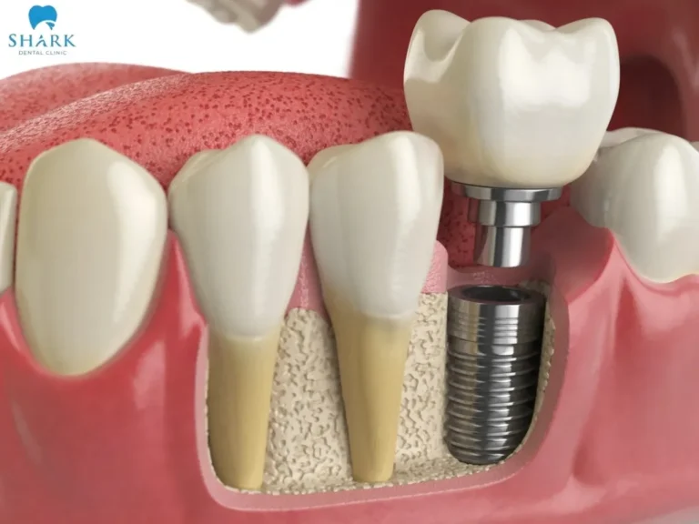 The time it takes for the implant post to fully integrate with the jawbone is usually about 3 – 6 months