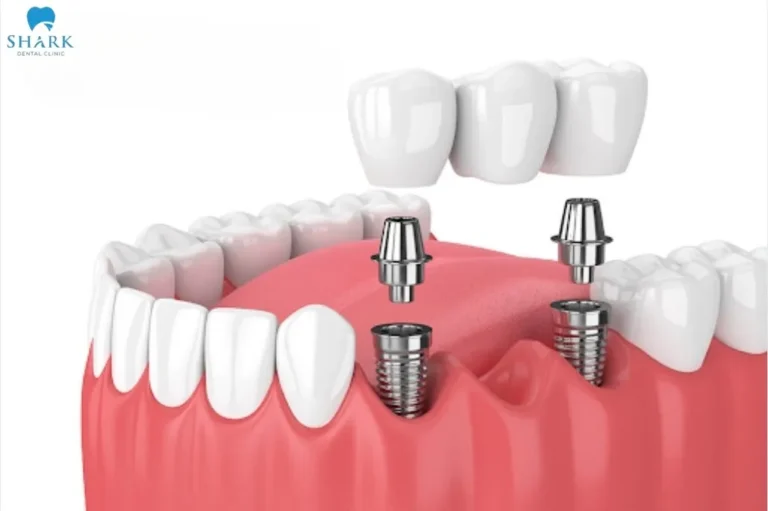 After the permanent crown is placed, you will have a new tooth with the same shape, color, and function as a natural one