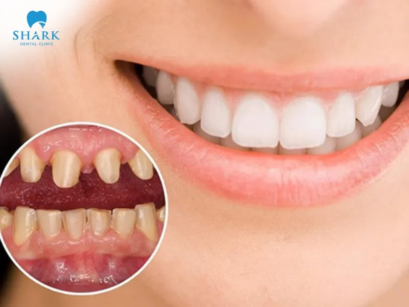 Porcelain crowns for front teeth help improve issues like yellowing, discoloration, and cracks
