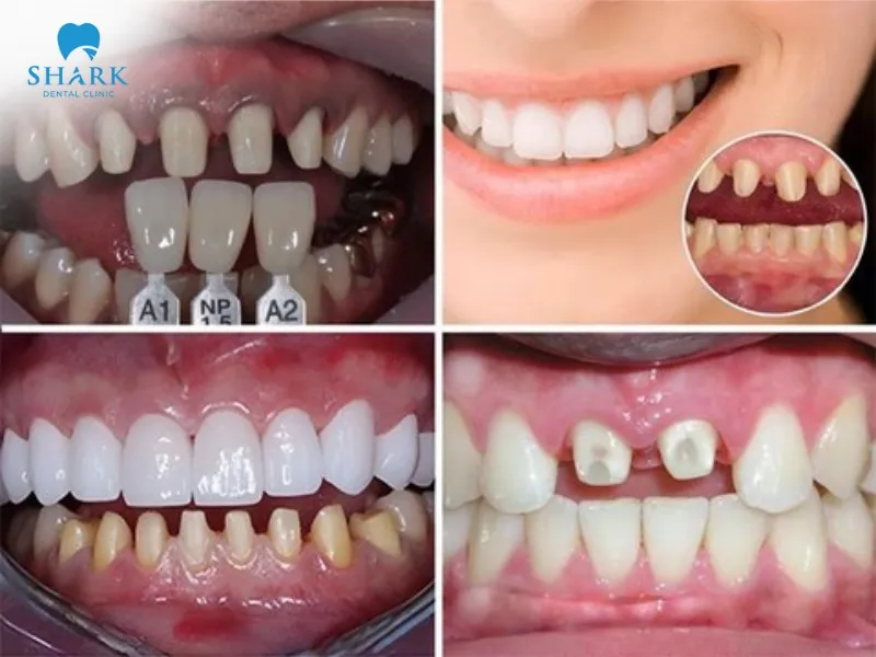 Porcelain crowns correct gaps between front teeth effectively