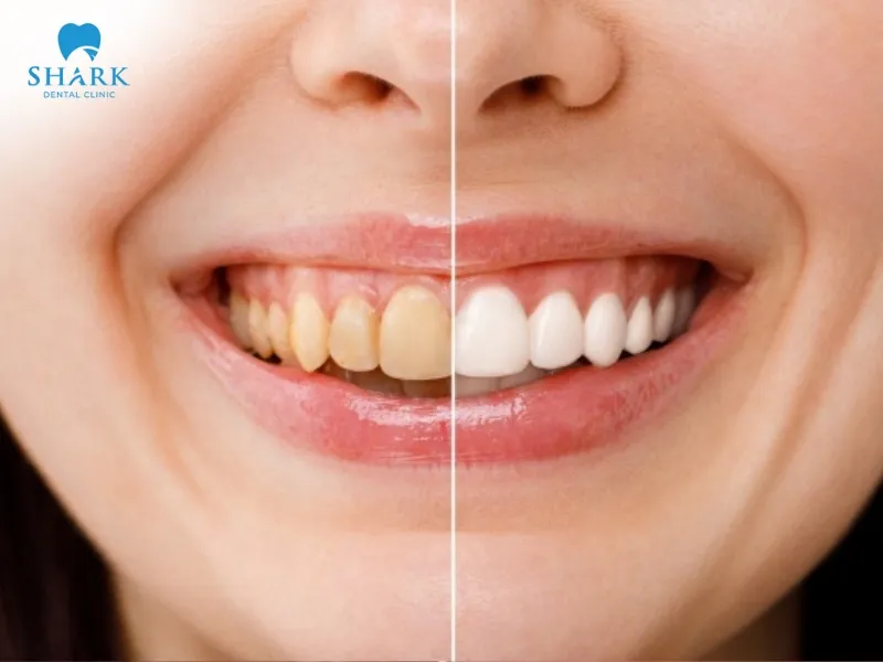 Porcelain crowns for discolored front teeth