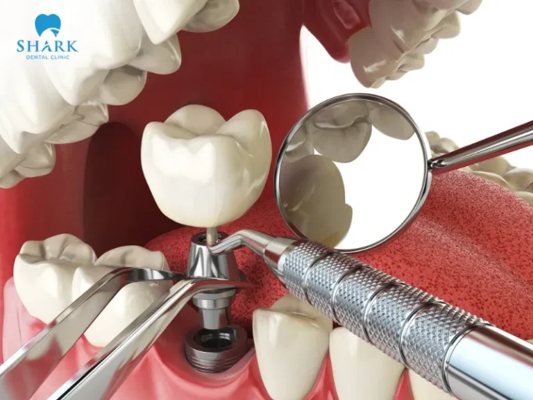 A single tooth implant involves inserting an implant post into the jawbone to replace a lost or damaged tooth