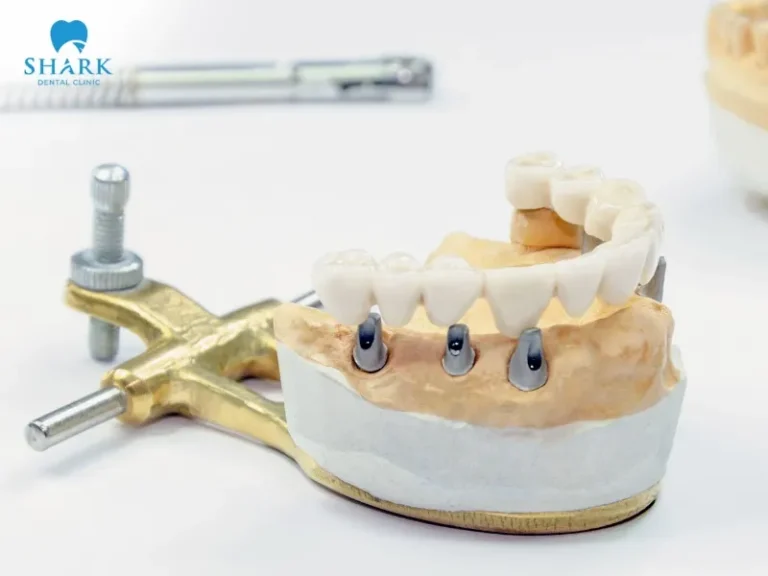 A full arch implant uses 4 to 6 implant posts that are placed into the jawbone to replace an entire row of teeth