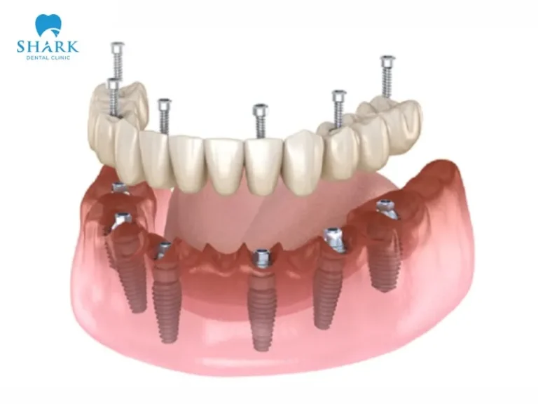 The All-on-6 implant involves using 6 implant posts that are inserted into the jawbone for a full set of teeth restoration