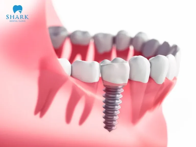 Immediate implants help shorten the procedure time and effectively prevent bone loss