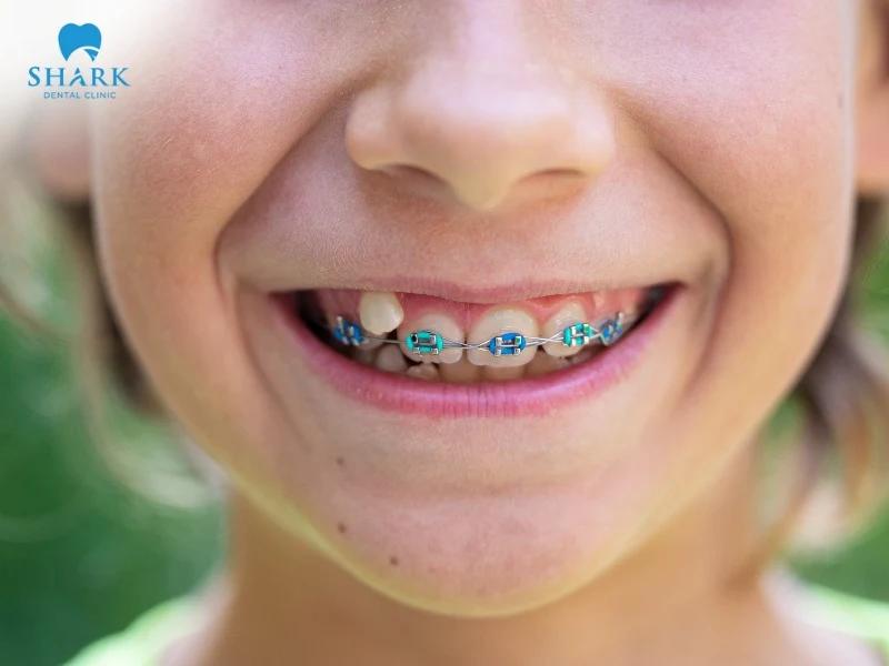 Children should undergo orthodontic treatment if their teeth are crowded or misaligned