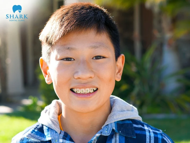 The best age for children to get braces is usually between 10 – 14 years old