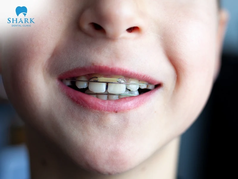 Getting braces at an early age helps ensure effective orthodontic results, shortens treatment time, and optimizes costs