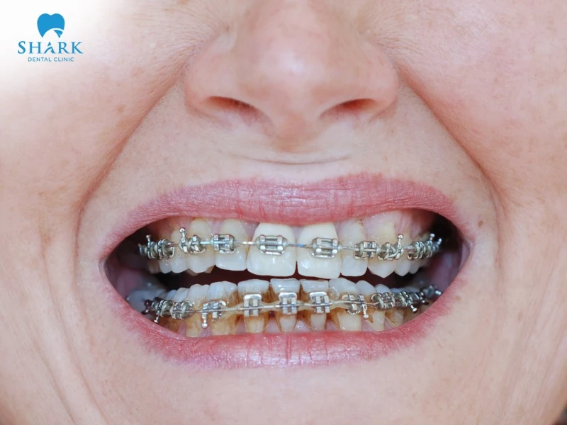 White spots on teeth after braces can be caused by fluoride exposure, poor diet, or unhealthy lifestyle habits