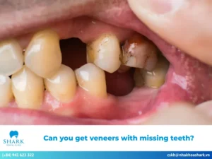 Can you get veneers with missing teeth?