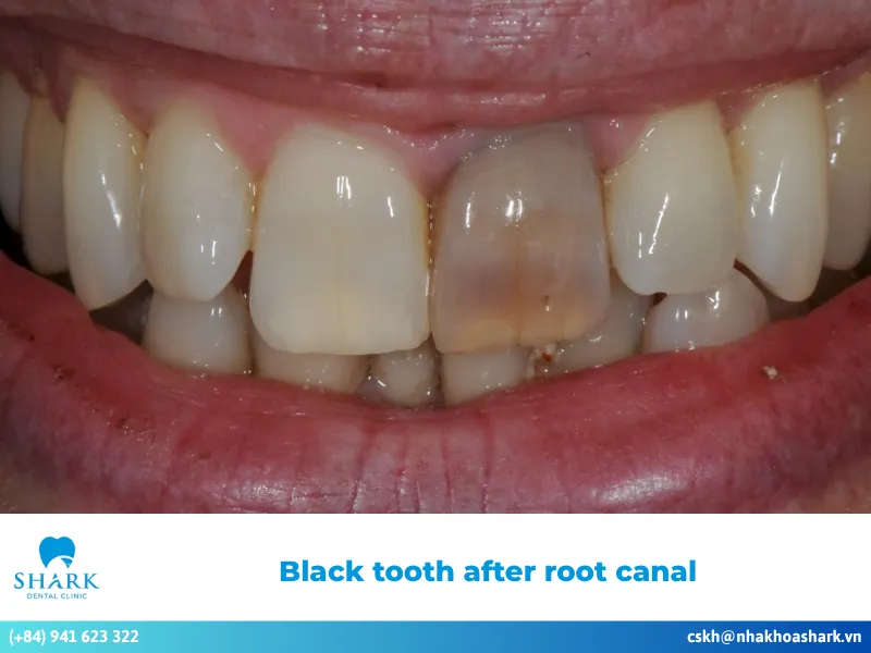 Black tooth after root canal