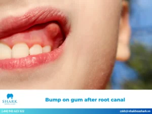 Bump on gum after root canal
