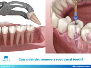 Can a dentist remove a root canal tooth
