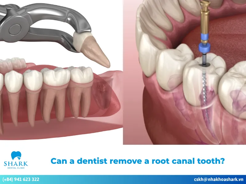 Can a dentist remove a root canal tooth