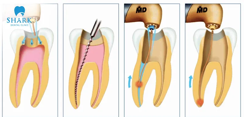 Root canal treatment is safe and not as dangerous as many people think