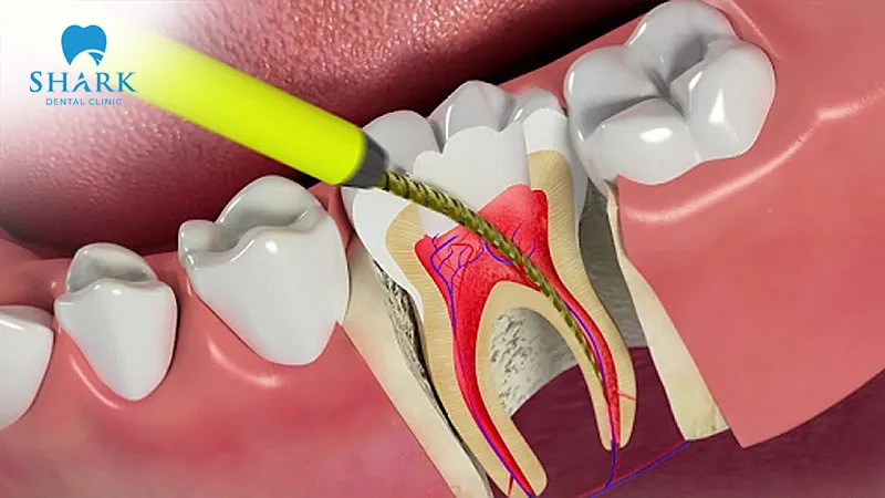 Root canal treatment stops severe tooth pain