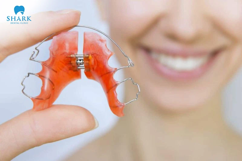 A palatal expander is used to create space for the teeth to move