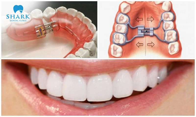 Palatal expansion can alter the structure of the face