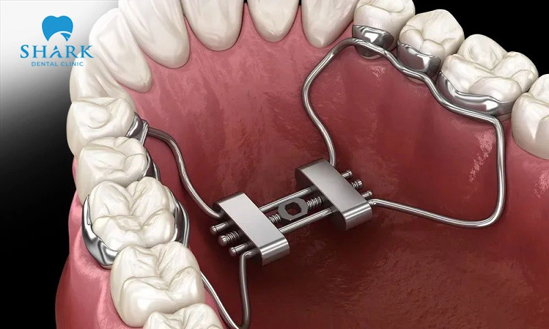 Depending on each case, the dentist will examine and recommend the appropriate palatal expansion method