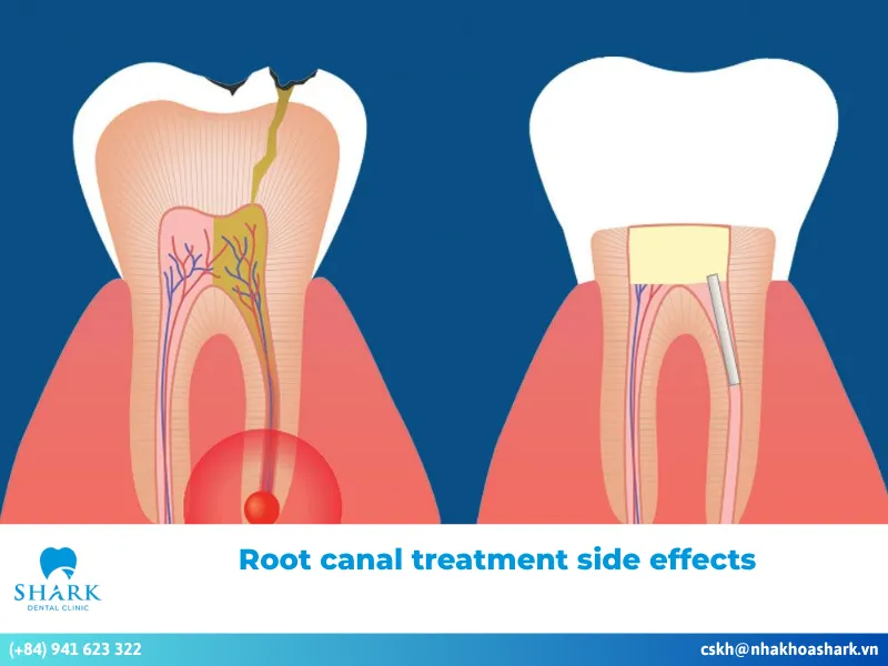 Root canal treatment side effects
