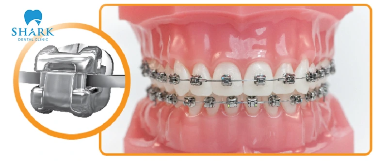 Self-ligating braces are designed with an automatic sliding mechanism that applies consistent pressure to the teeth
