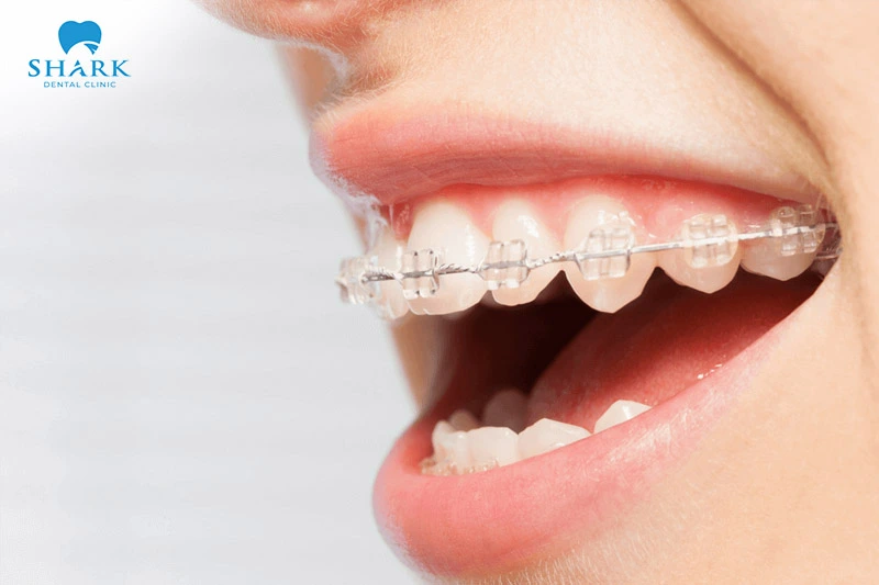 Self-ligating braces offer many advantages in terms of safety and biocompatibility, helping to minimize irritation in the oral cavity