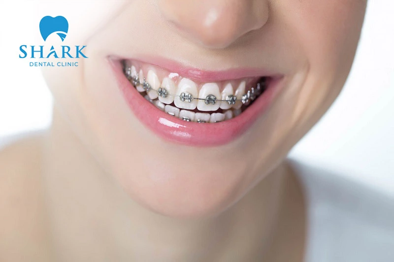 The cost of self-ligating braces is higher than that of traditional braces