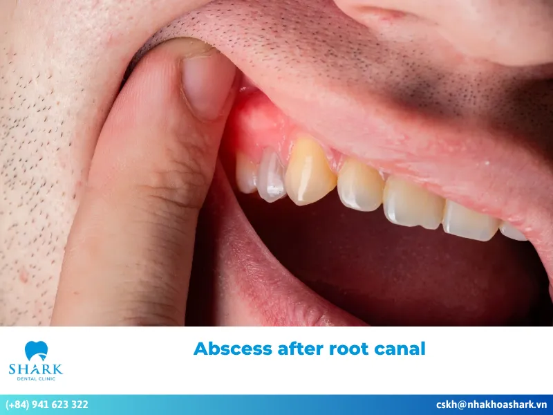 Causes of abscess after root canal