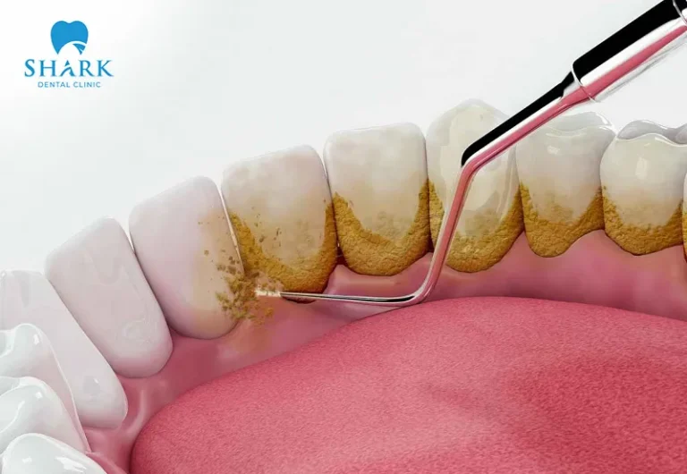 Teeth are more sensitive and prone to irritation after scaling