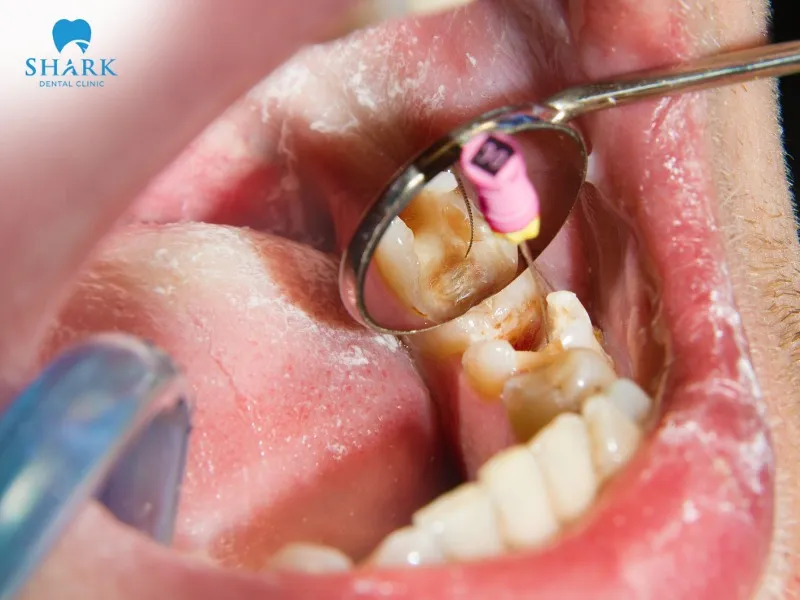 Pain after a root canal may be caused by infection or errors during the treatment process