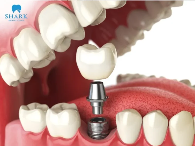 Currently, the cost of a single tooth implant in Vietnam ranges from 16,000,000 to 65,000,000 VND per tooth