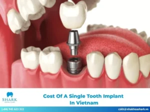 Cost of a single tooth implant in Vietnam